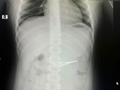 Врачи Уфы извлекли маникюрные щипцы из желудка шестилетнего мальчика