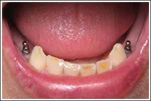 Dental Implants