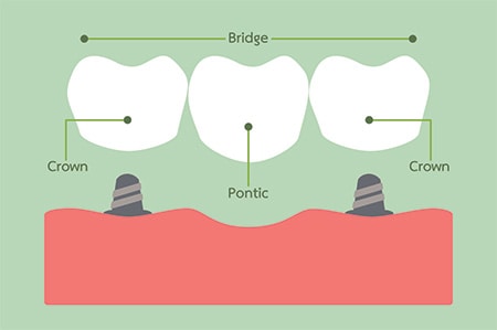 Bridge placement