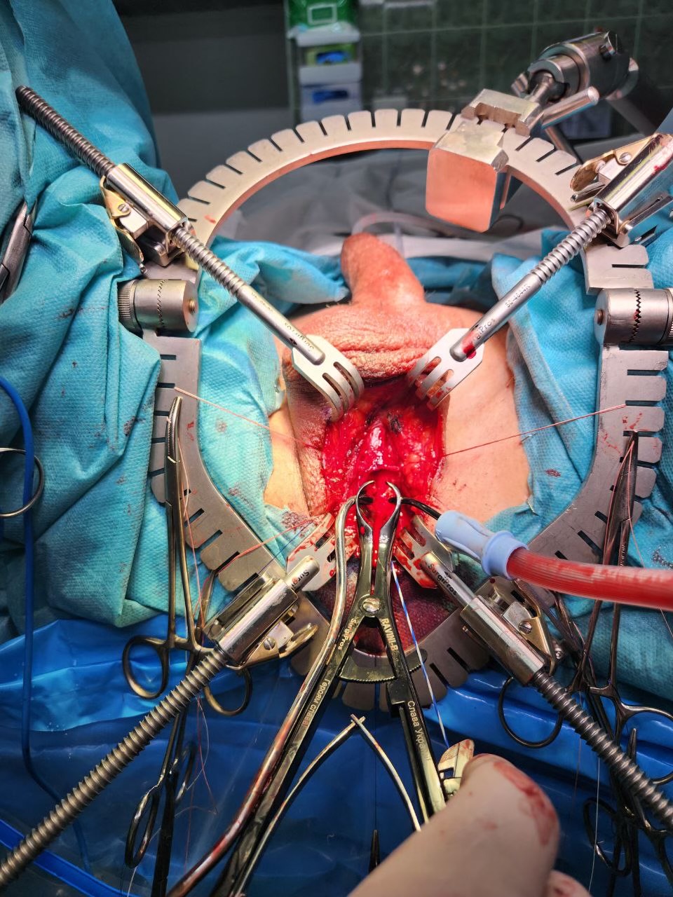 JORDAN SIMPSON PERINEAL RETRACTOR KIT COMPLETE