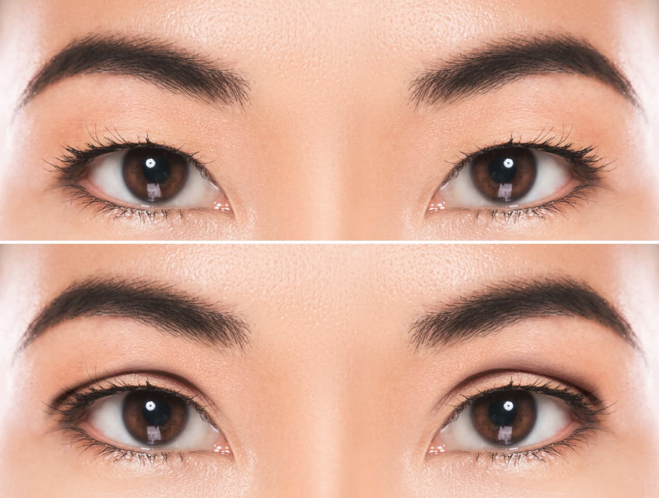 double eyelid procedure