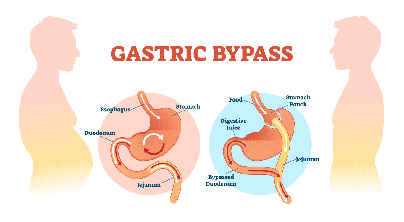 5 Fascinating Facts About Gastric Bypass Surgery On Morbidly Obese