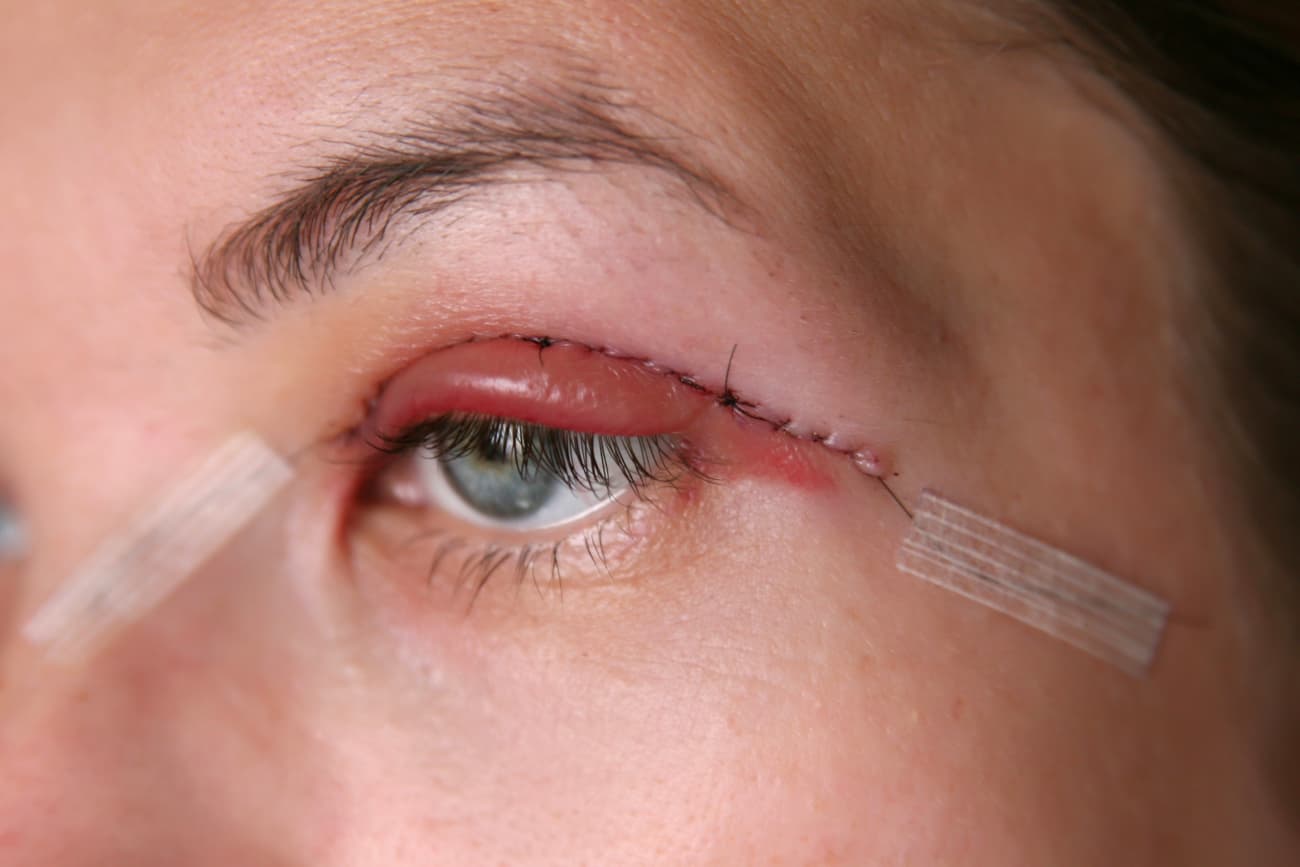 permanent double eyelid without surgery