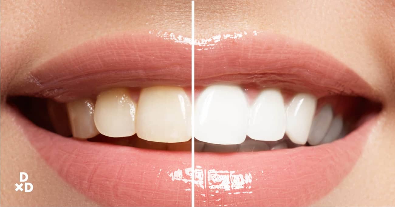 Teeth Whitening Services Singapore - inspire ideas 2022