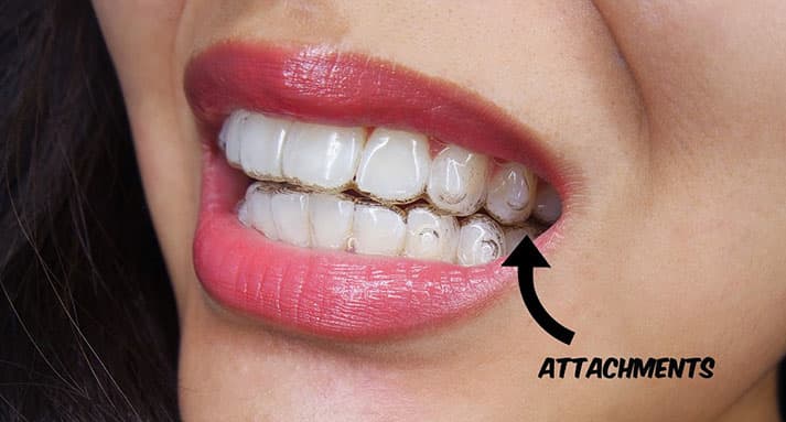 6 Hacks After Invisalign For A Perfect Teeth