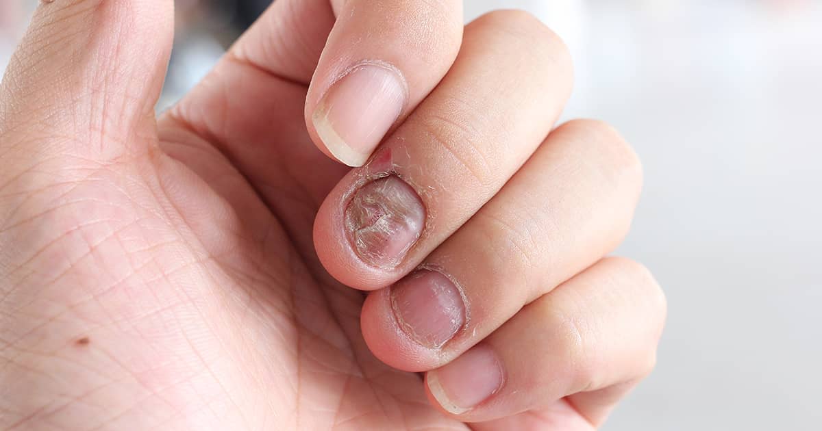 Treating Fungal Nail Infections: Tips From A Singapore Dermatologist