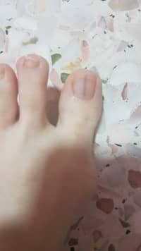 How do I get rid of a brown line on my toe nail? (photo) - human