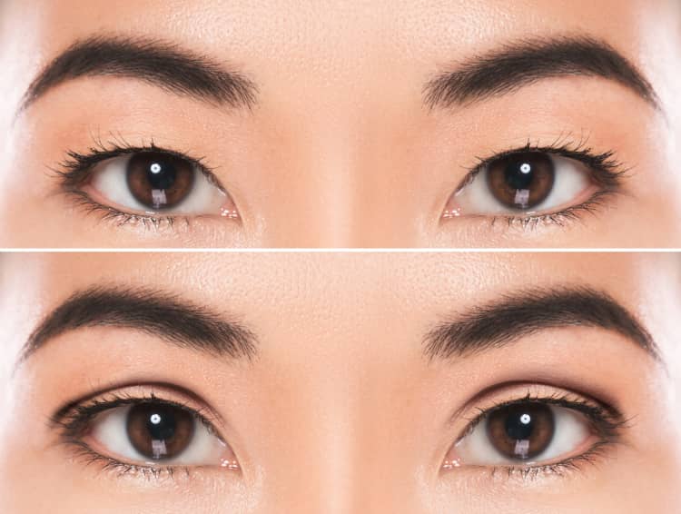 3 Types of Double Eyelid Surgery