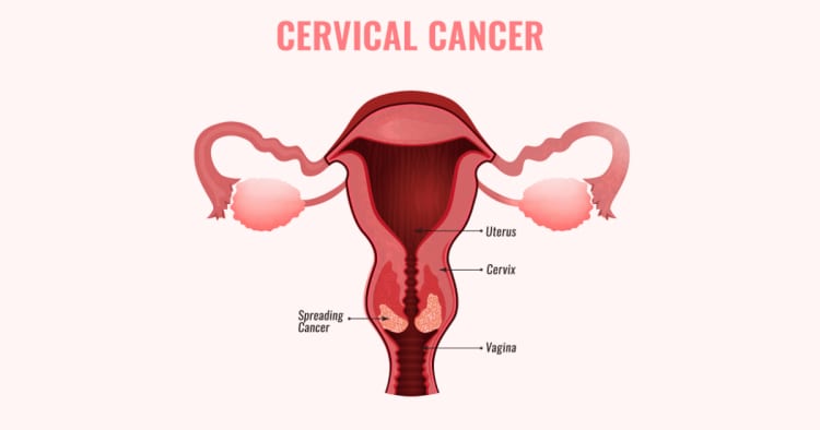 The Ultimate Guide to Cervical Cancer in Singapore (2021)