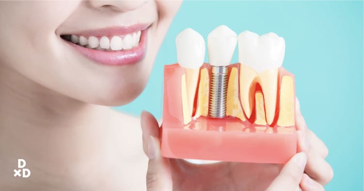 The Ultimate Guide to Dental Implants in Singapore (2021)