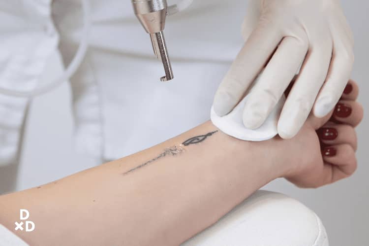 The Ultimate Guide to Tattoo Removal in Singapore (2021)