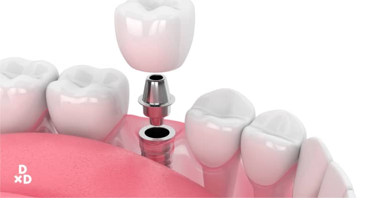 The Ultimate Cost Guide to Dental Implants in Singapore (2021)