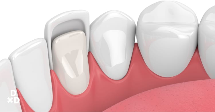 The Ultimate Cost Guide for Dental Veneers in Singapore (2021)