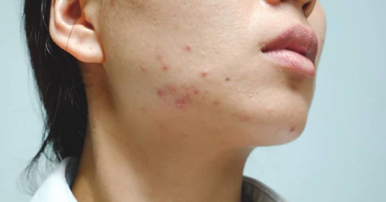 9 FAQS About Acne Scar Treatment In Singapore