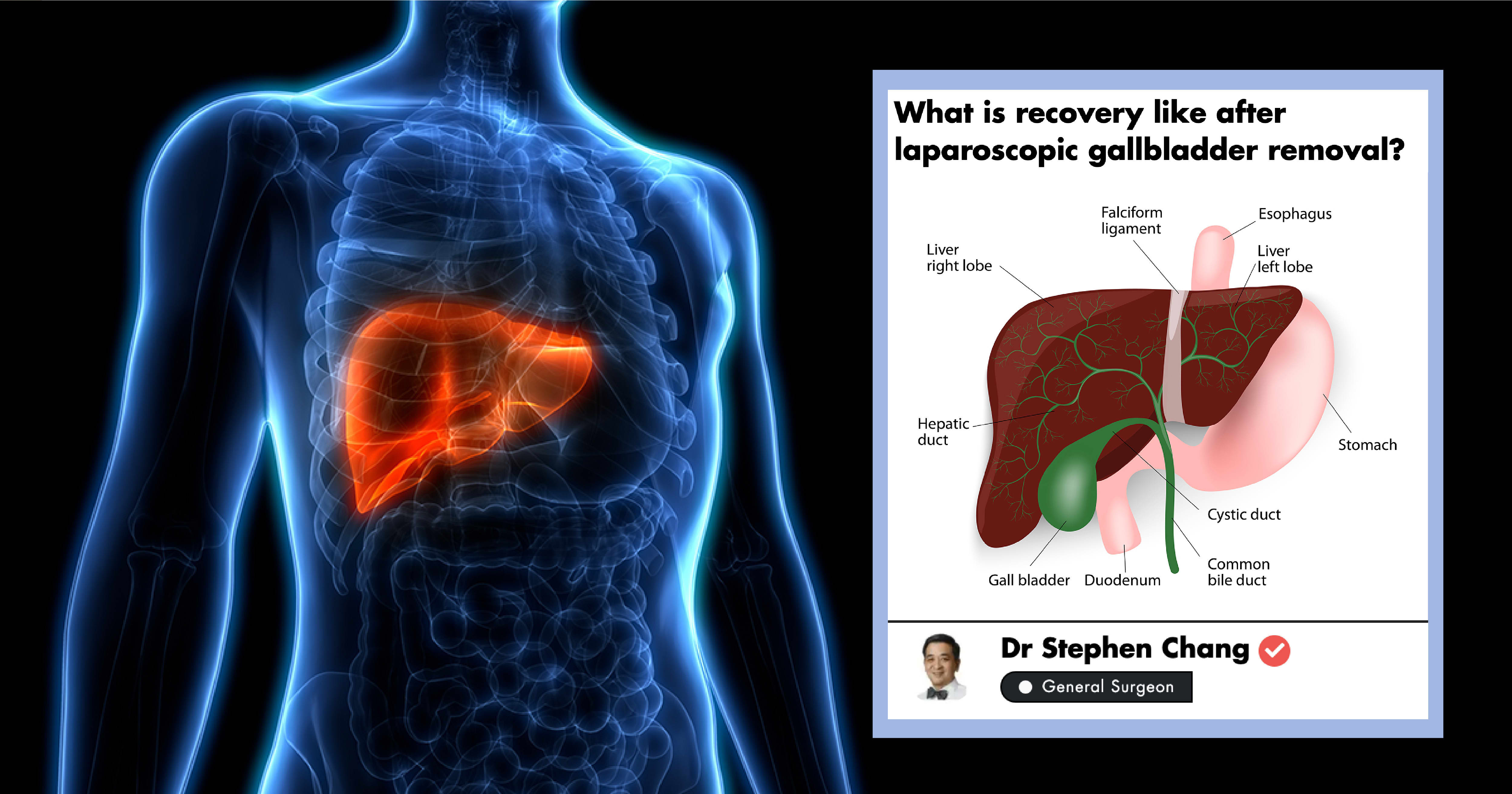 When To Remove The Gallbladder Surgeon Discusses Surgery And Recovery