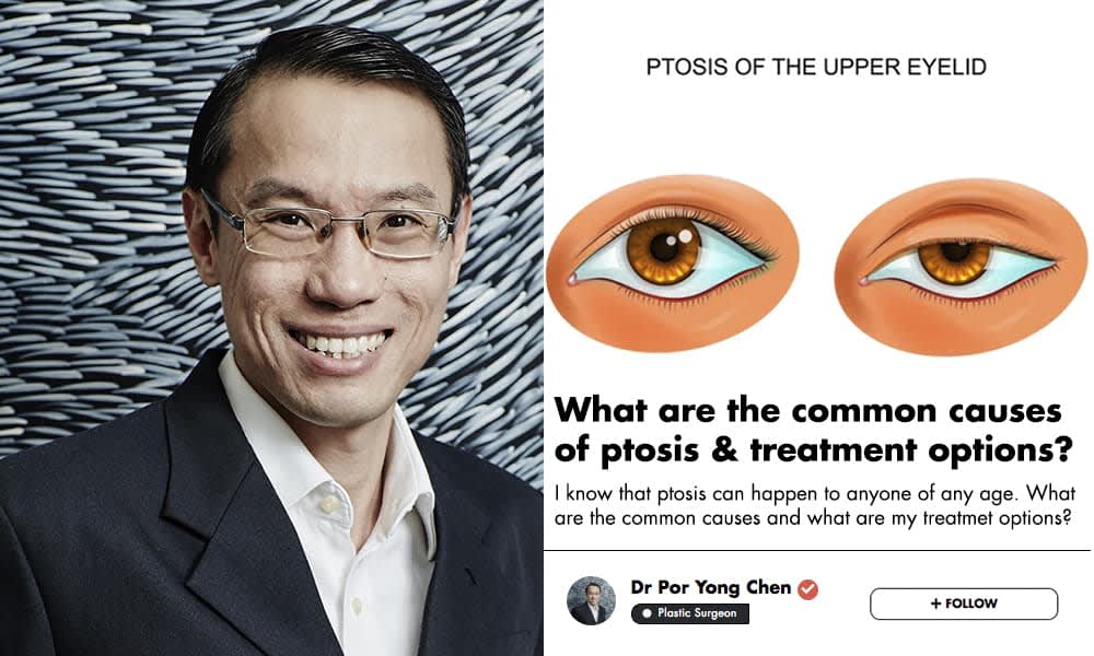 Drooping Eyelids Are A Real Medical Condition This Singaporean Plastic Surgeon Explains How To Fix It Human