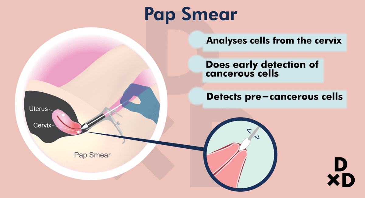 Getting a Pap Smear in Singapore: The Ultimate Guide To ... 