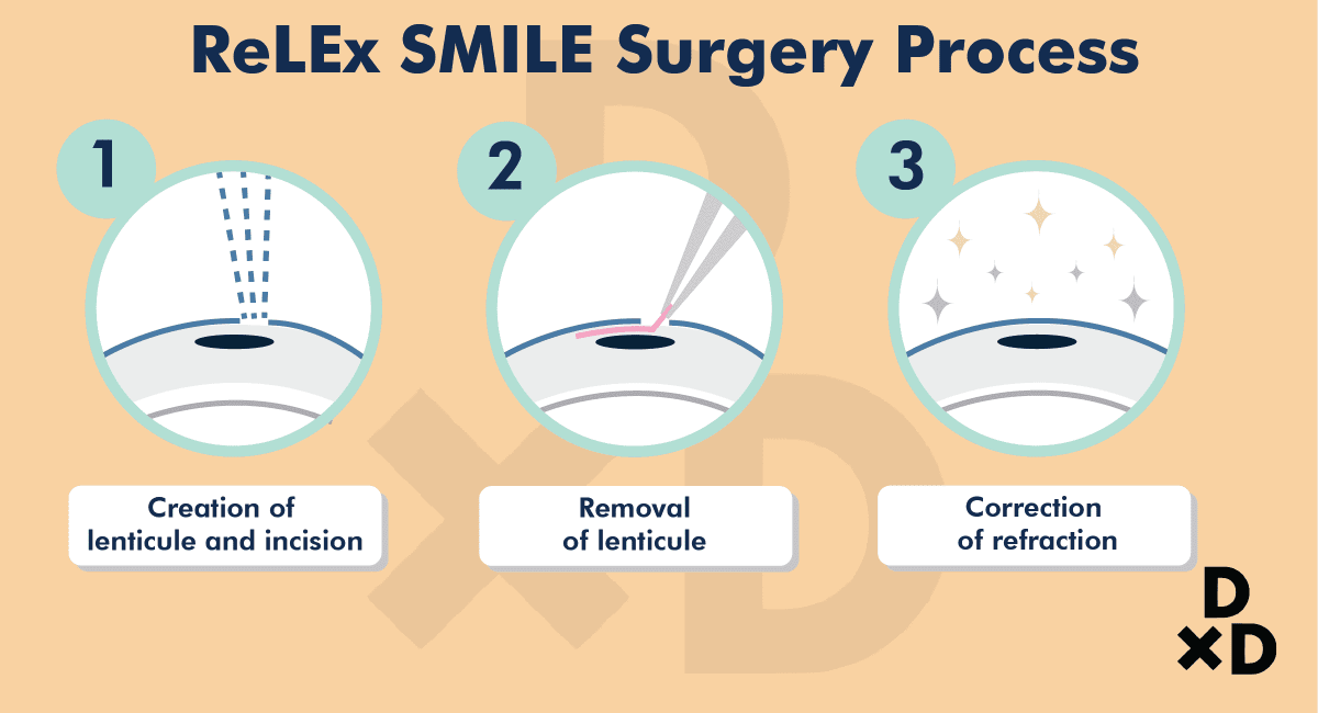 Relex Smile In Singapore The Complete Guide By An Eye Doctor 2020