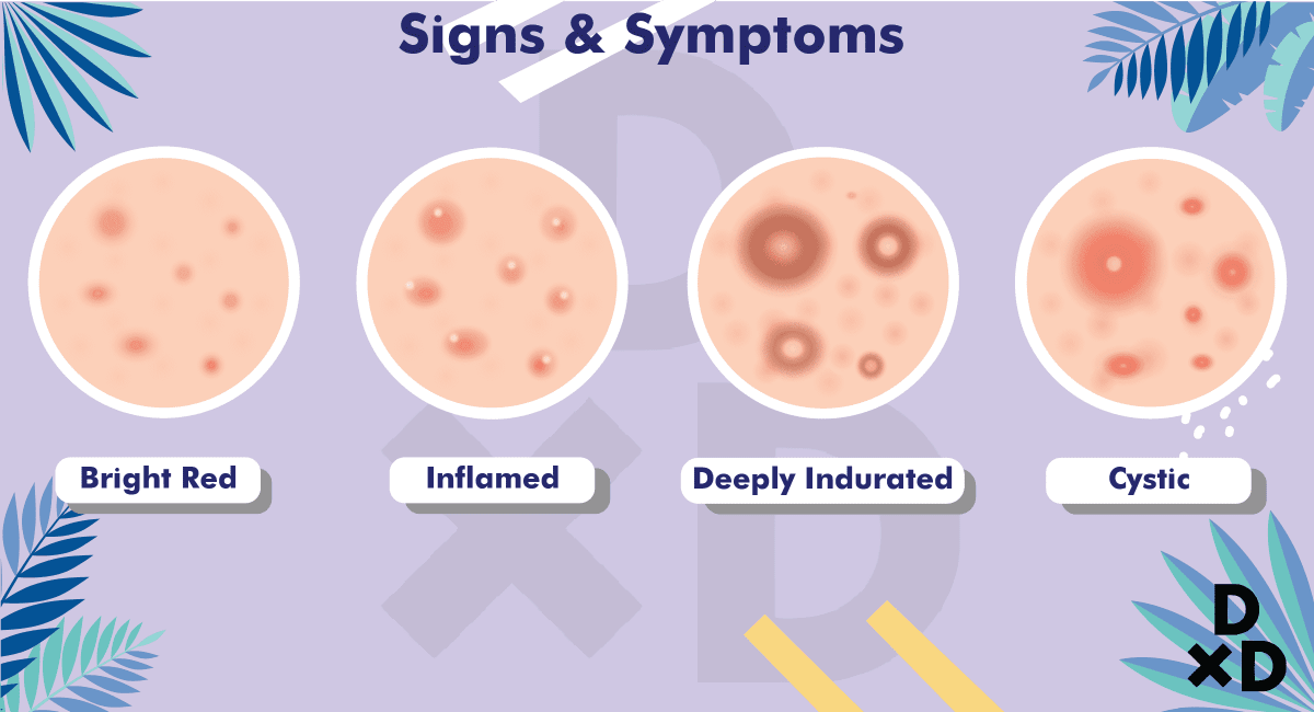 Pathophysiology Of Acne