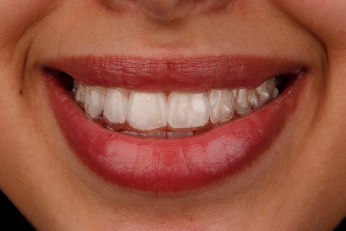 invisalign aligners odontoiatria estetica cosmetica orthodontic treatment