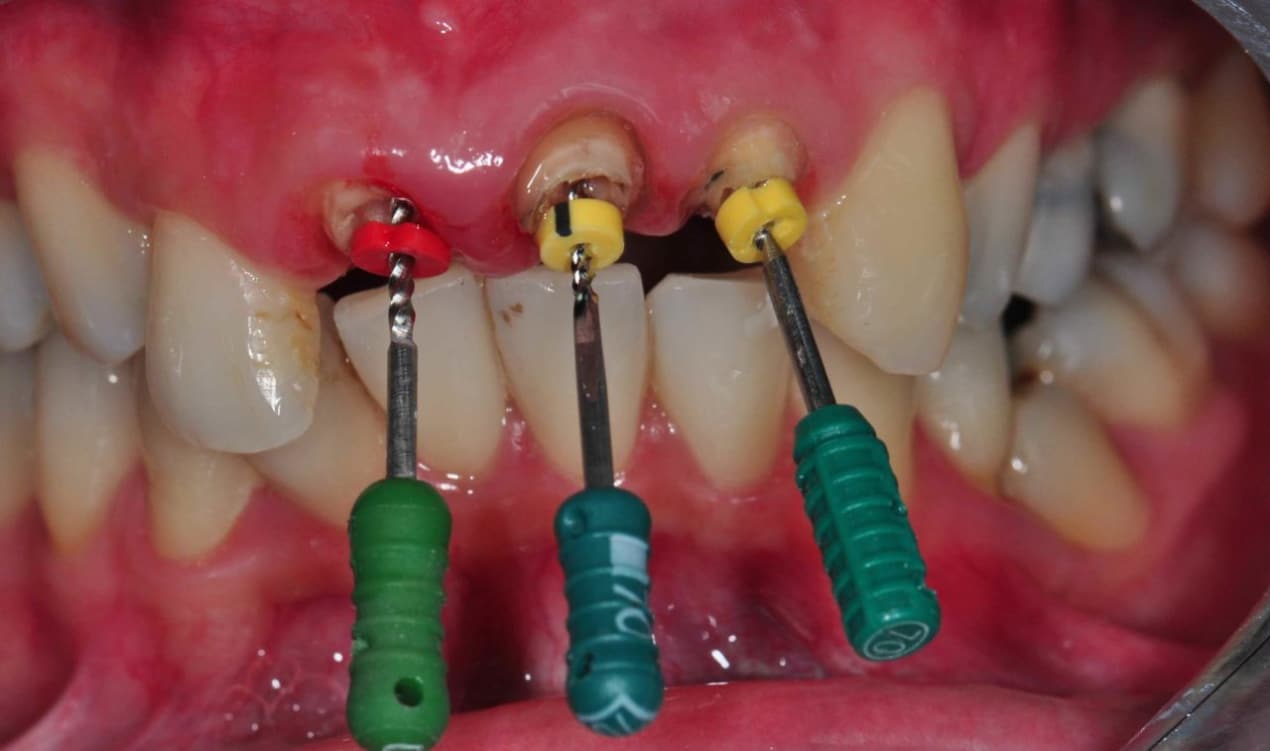 Root Canal Treatment Is Totally Badass (And 5 Common Misconceptions) undefined