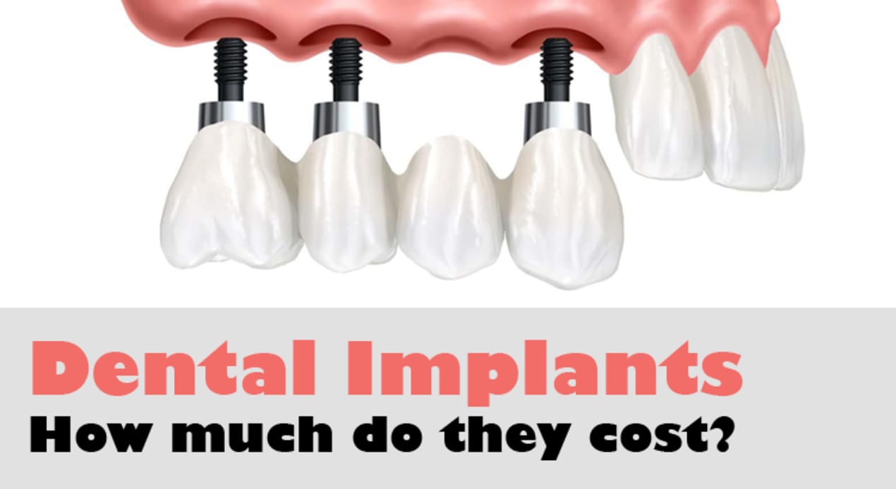 Dental Implant Costs In Singapore: A Dentist Tells All undefined