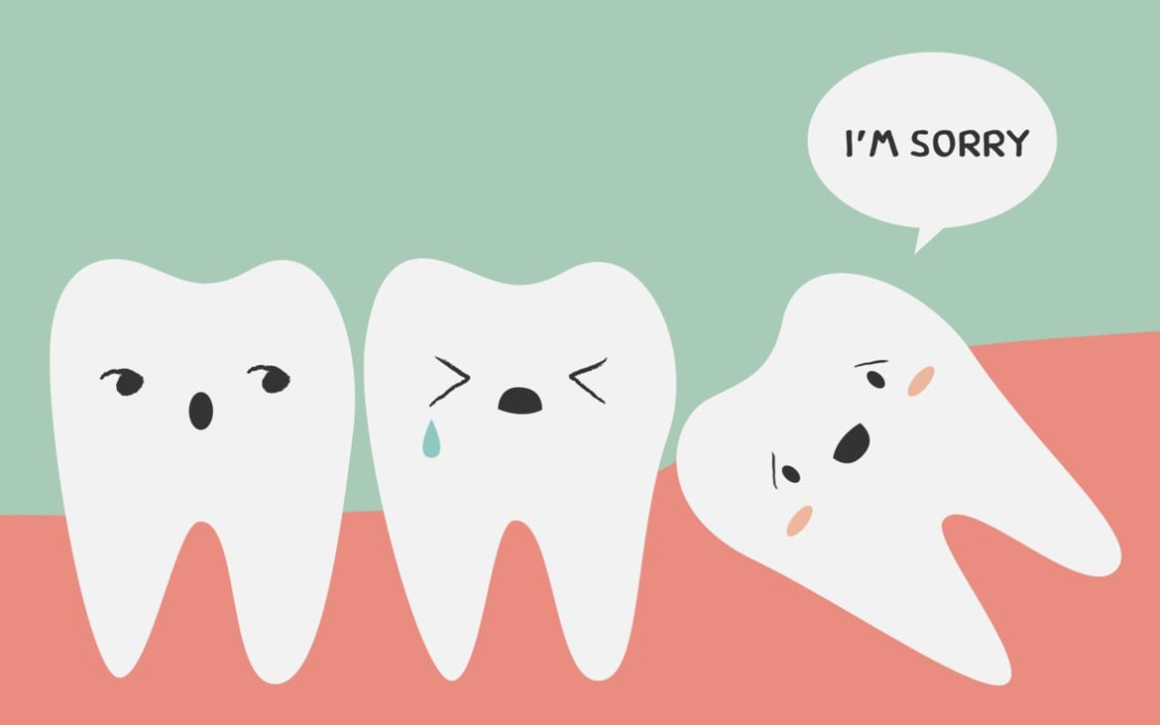 Guide To Wisdom Tooth Extraction Costs In Singapore (2018) undefined