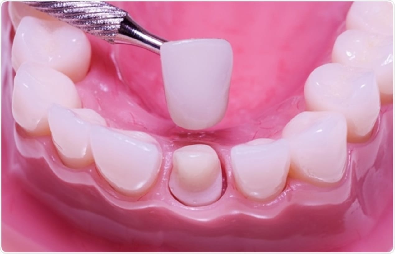 Everything You Need to Know About Dental Crowns and Bridges In Singapore (2018) undefined