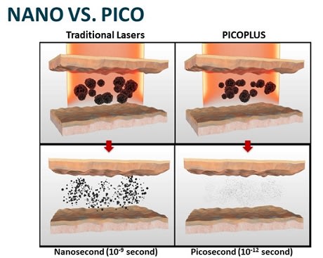 picosecond vs nanosecond laser