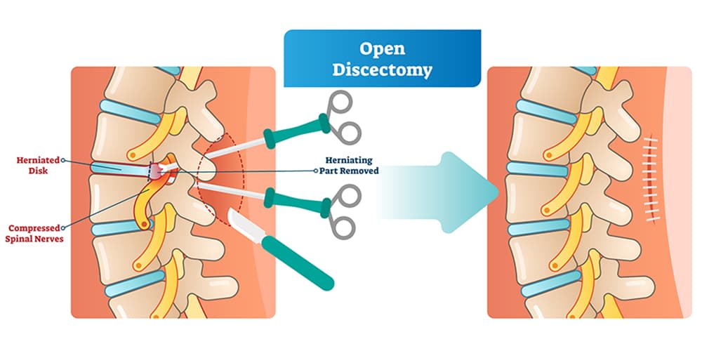 When Do You Need Surgery For A Slipped Disc? A Spine ...