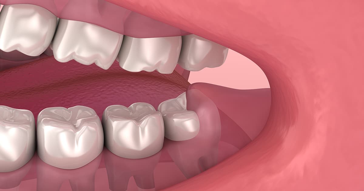Your Wisdom Tooth Removal Concerns Addressed: Tips From A ...