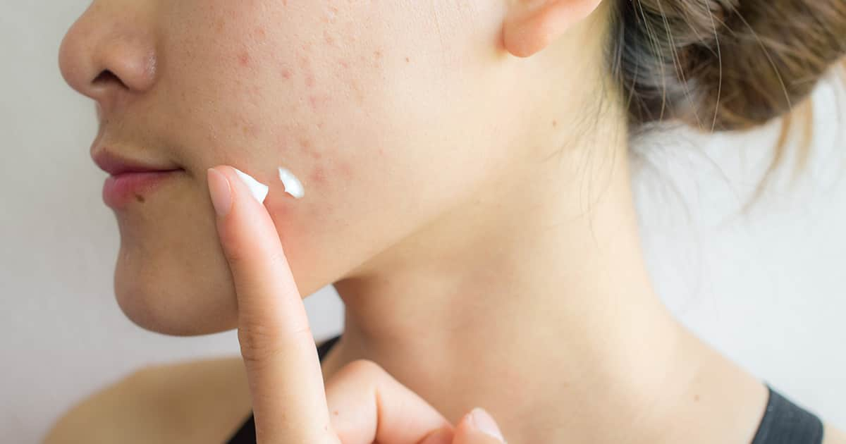 Treating Active Acne Versus Acne Scars The Differences Explained