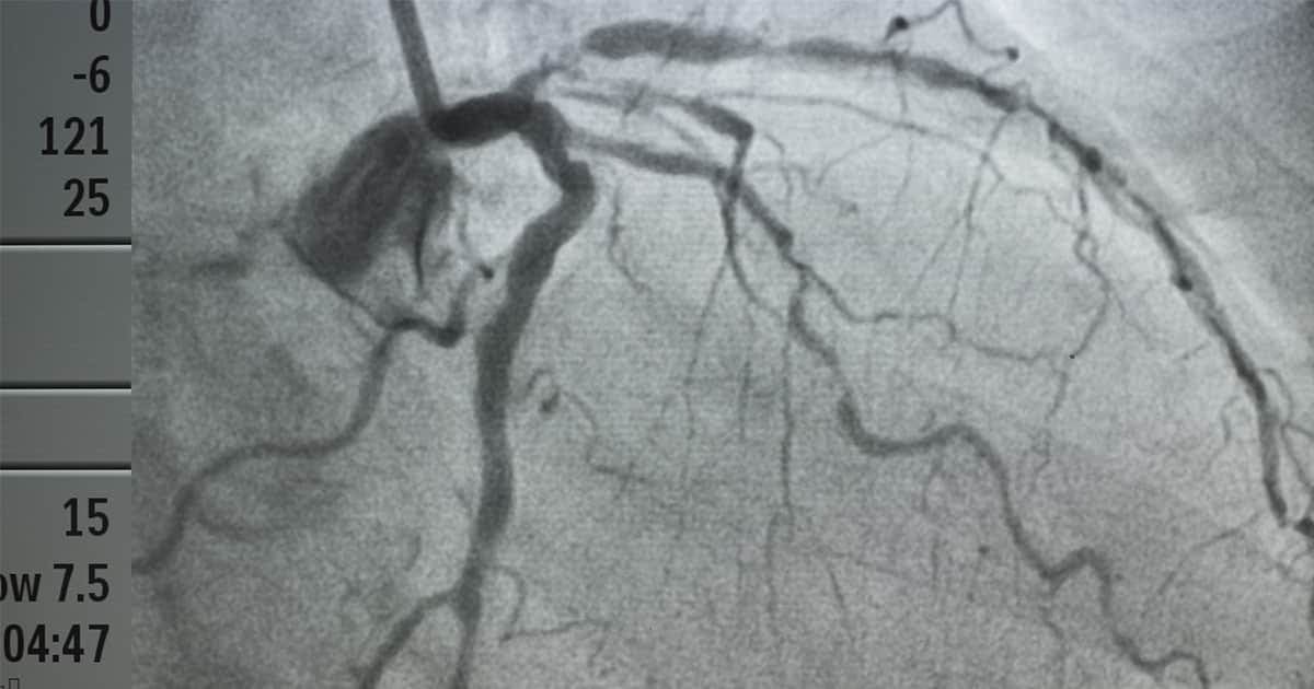 coronary-heart-angiogram-image