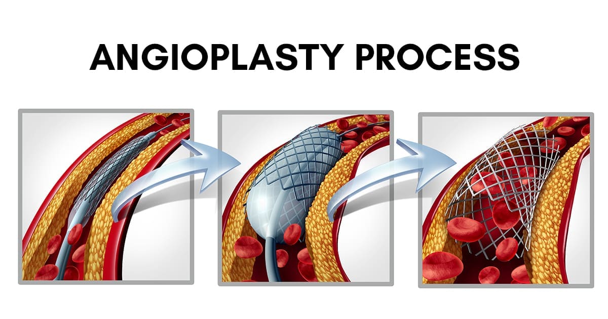 Angiogram Vs Angioplasty What Is The Difference A Cardiologist