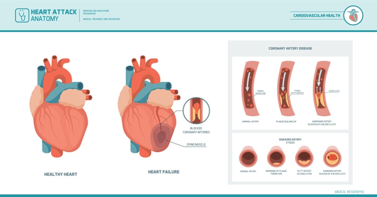 coronary-arteries-heart-attack-illustration