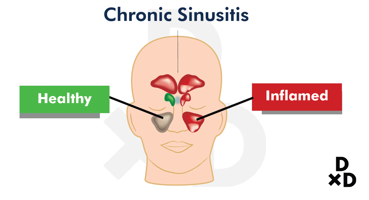 chronic-sinusiitis