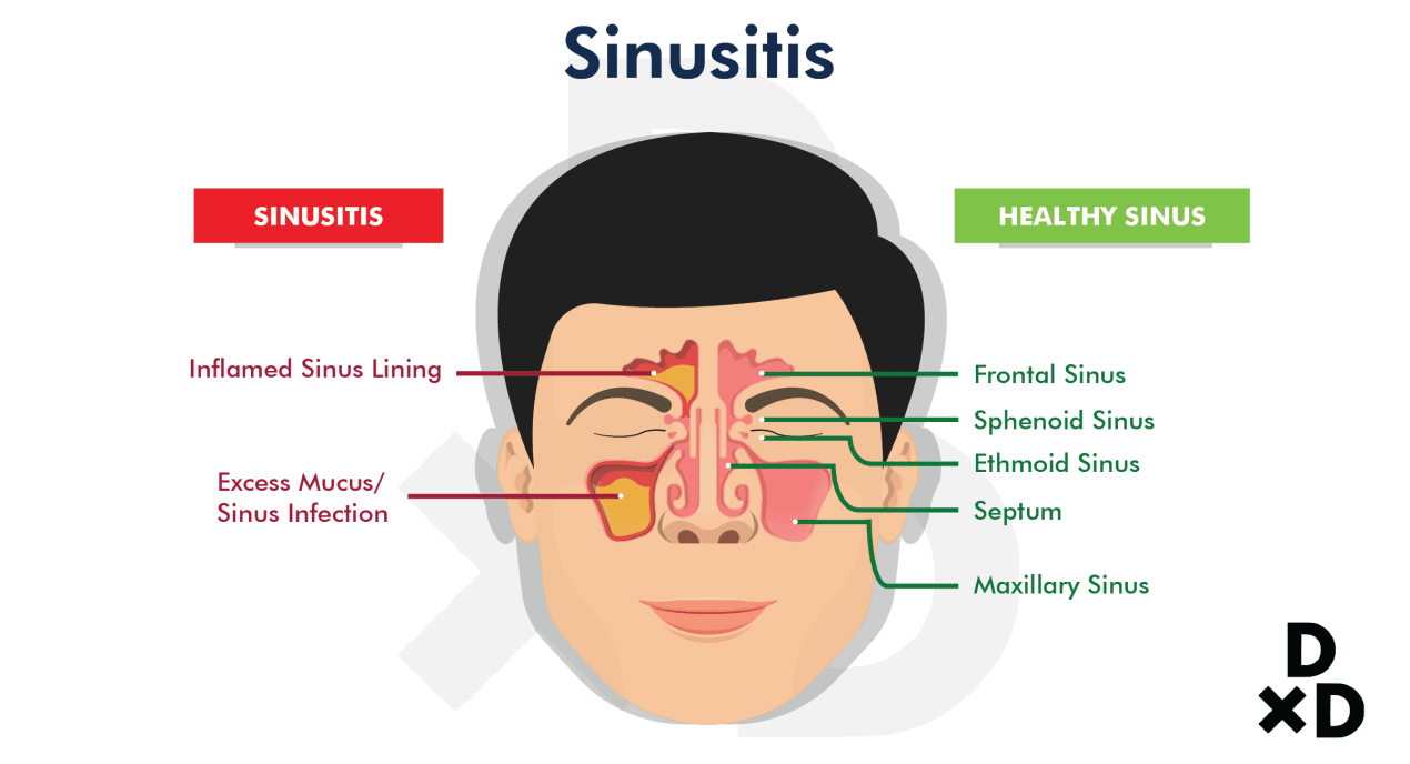 sinusitis