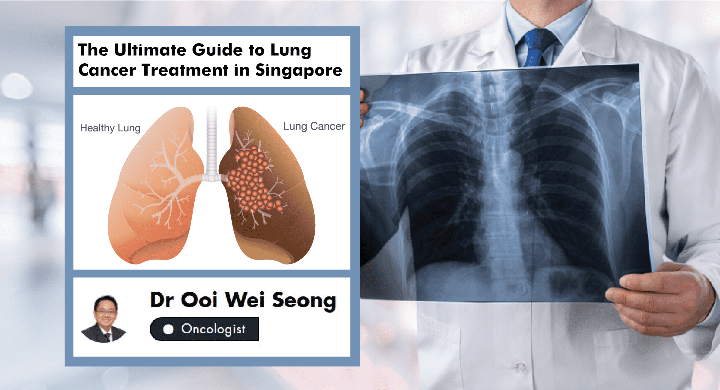 Lung Cancer Treatment in Singapore An Oncologist's