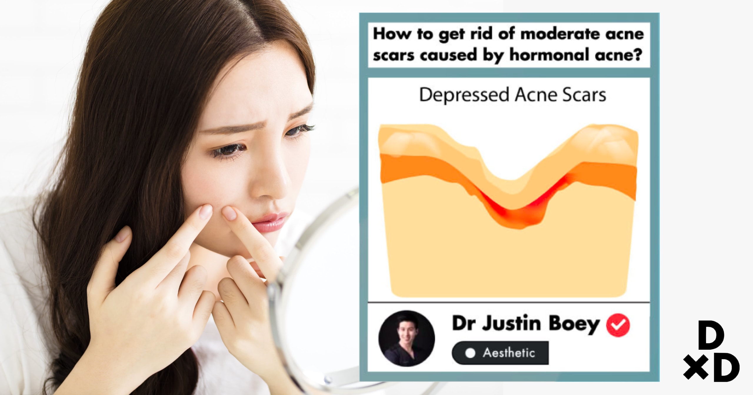 Guide To Best Acne Scar Treatments In Singapore 2020