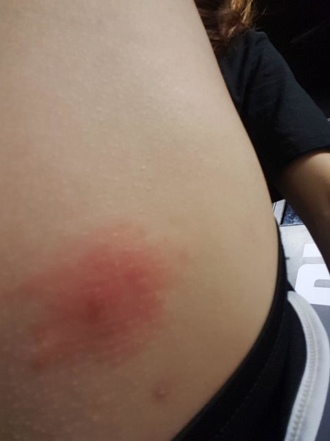 How do I distinguish between an insect bite or huge pimple ...