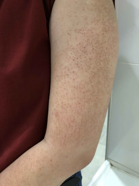 Keratosis Pilaris Laser Treatment