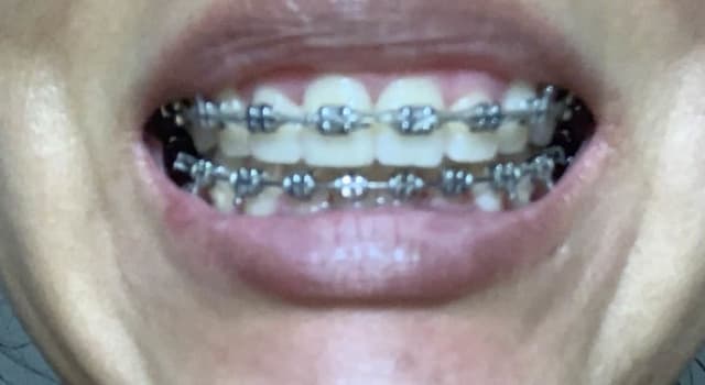 When is it recommended to shave down front teeth to treat ...