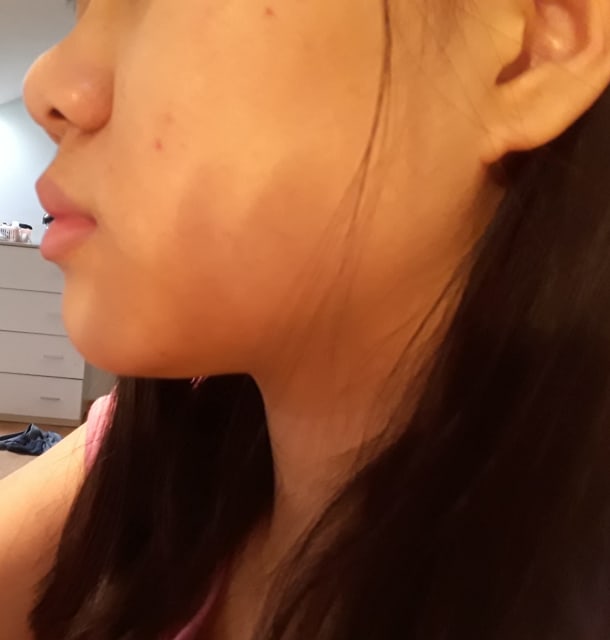 What are the treatments available to correct protruding ... What are the treatments available to correct protruding ...