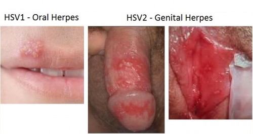 Genital herpes std testing singapore