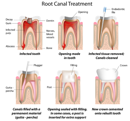 root canal treatment