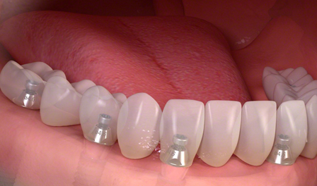 dental implant singapore