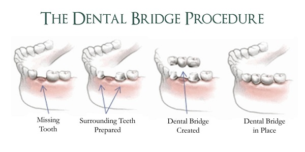 dental bridge singapore