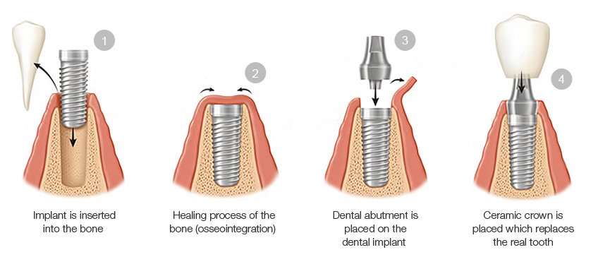 illustration of dental implants