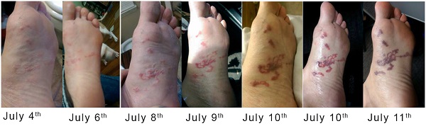 Cutaneous larva migrans