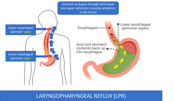 Laryngopharyngeal reflux